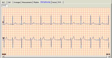 The durations are expressed in milliseconds. The measurements cannot be edited. Rhythm view When you have recorded a rhythm ECG, you can view the entire ECG in the Rhythm view.