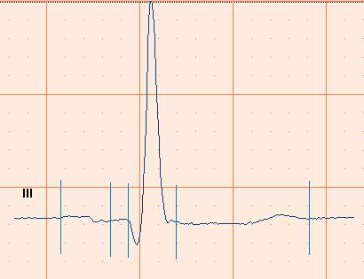 interpretation of an ECG. You can remove this noise with a muscle noise filter. To apply a muscle noise filter: In the Action menu, click Muscle noise filter. 4.12.