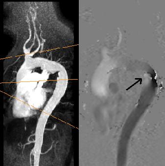 6 Hemodynamic Boundary Conditions A region of interest (ROI) defined the vascular area on the Phase Contrast (PC) quantitative images to extract velocity data samples.