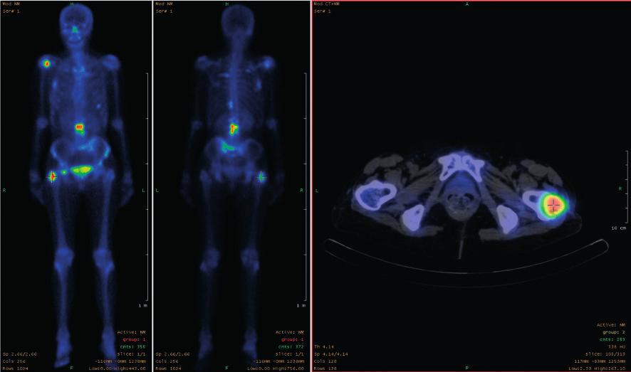 palettes in triple fusion: AC PET (green), NAC PET (Red), CT (gray) Whole Body bone SPECT AP - PA