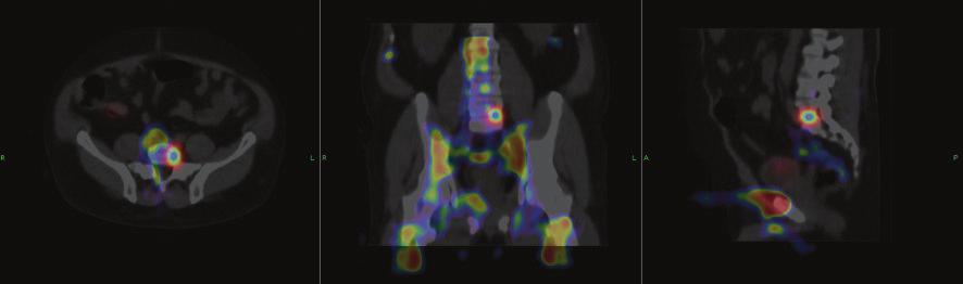 A SPECT/CT dual fusion