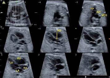 The recent introduction of the multislice analysis known as Tomographic Ultrasound Imaging (TUI) is similar to the tomographic assessment known from CT and MR workstations.