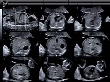 The multiplanar mode can be used to acquire a plane not directly seen on cross section 2D during live examination, mainly in cases with non-optimal fetal position, so as to demonstrate the corpus