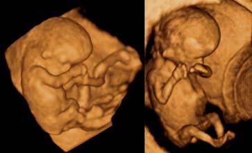 Surface mode rendering The image rendering of the fetal surface is the most known and commonly used display modality in 3D and 4D.