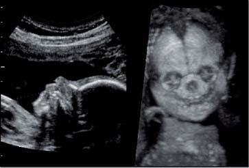 Within the box, the presence of amniotic fluid should be avoided as it casts a large black shadow. Images produced with this technique are similar to x-ray projection.