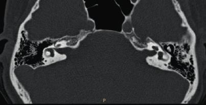 It reduces helical MDCT imaging artifacts and provides improved high-resolution 32-slice images that are clinically equivalent to those resulting from ZFS standard