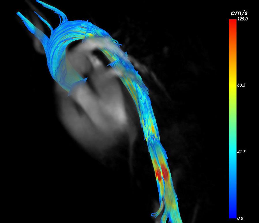 Originating from multiple and freely selectable emitter planes, aortic flow can be visualized by