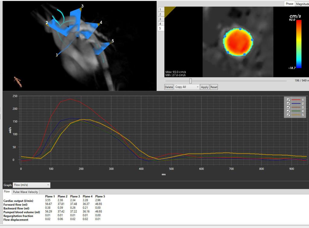 2D Flow Parameters A 2D flow phase contrast analysis in the 3D volume can be performed in just a few clicks. You can freely place multiple planes throughout the aorta for 2D velocity analyses.