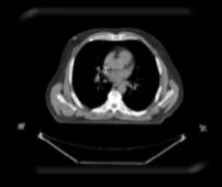 Annihilation Photon Attenuation PET/CT Attenuation Correction (AC) Anti-parallel gamma ray coincidence detection means that