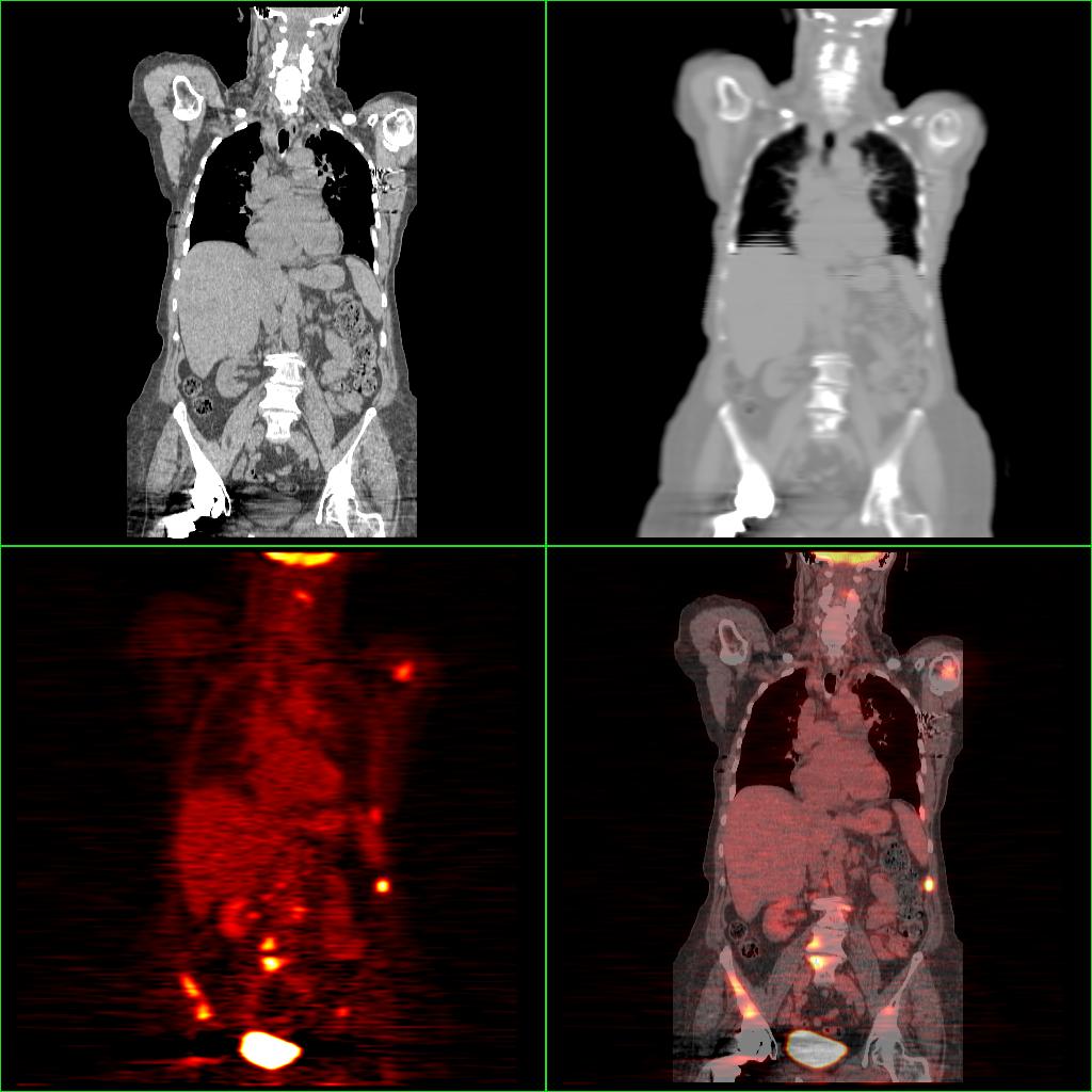 PET images Reconstructed PET/CT images p p p ( k) compare measured and estimated projection data f (k) f (k+1) update image estimate based on