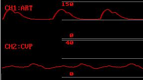UAP: Left Atria Pressure Umbilical arterial pressure SYS MEAN DIA FAP: Femoral arterial