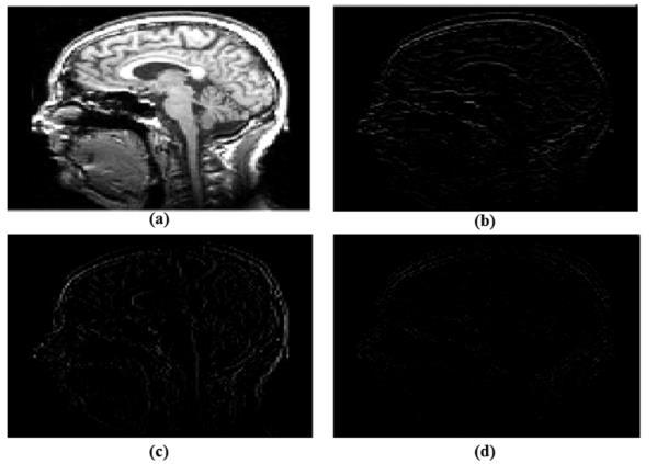 interpretation and diagnosis. This paper presents an improved contrast and enhancement in image quality by using DWT, SIDCSIHE, and SVD along with masking approach. A.