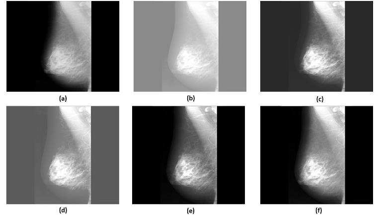 7 and 8) supremacy of the proposed method is to show normal fatty tissue, dense breast tissue and infected area clearly. Fig. 4.
