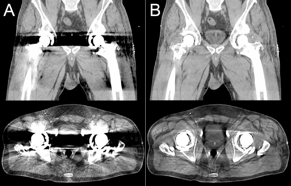 Patient with hip implants w/o MAR with MAR From: Axente M, et al.
