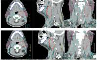 adaptive radiotherapy. CBCT FBCT T.