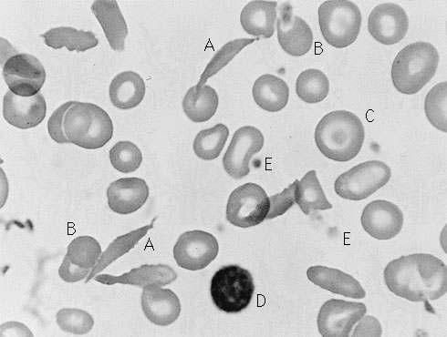 Classification Tasks Diagnosing sickle cell anemia Features, X
