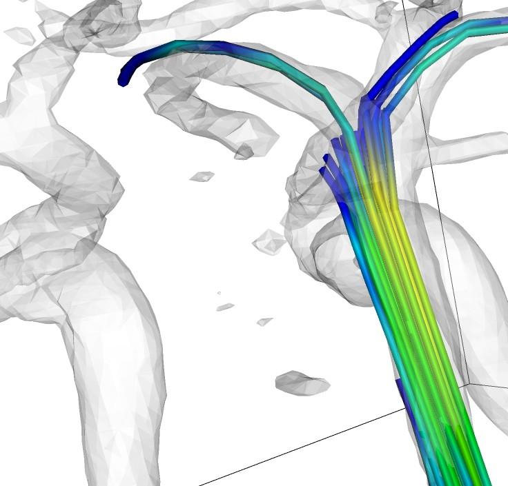 Example : carotid artery Visualisation using VTK streamlines