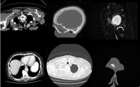 V. CONCLUSIONS Fig 3: Examples of CT images from TCIA database Each database image of database is considered as a query image and matched with all images.