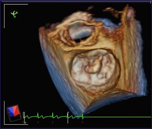 Volume Rendered Images Displays Anatomy and Pathology Dynamic images Thresholding/ Gain adjustments needed Ideal Volume