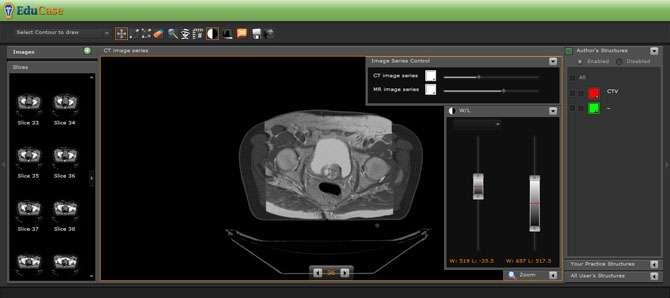 15 Contouring Tools Image Series Controls When multiple studies are downloaded, such as a planning CT and an MRI study, the studies can be viewed individually or as blended images.