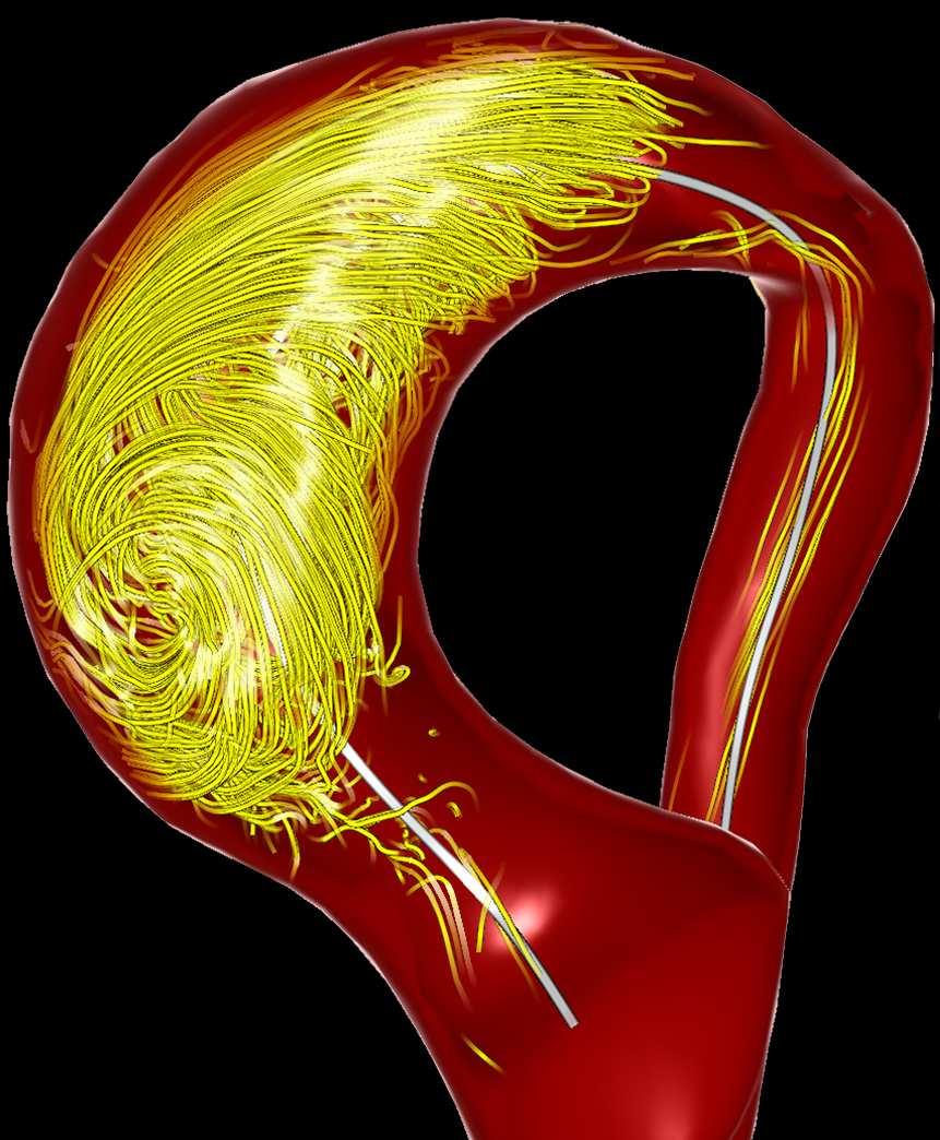 Vortex Animations with Adaptive Speed (VAAS) 3 (a) (b) (c) (d) Fig. 1. (a) Animation of extracted vortex flow in a patient with a dilated ascending aorta. (b) Viewdependent vessel mask.
