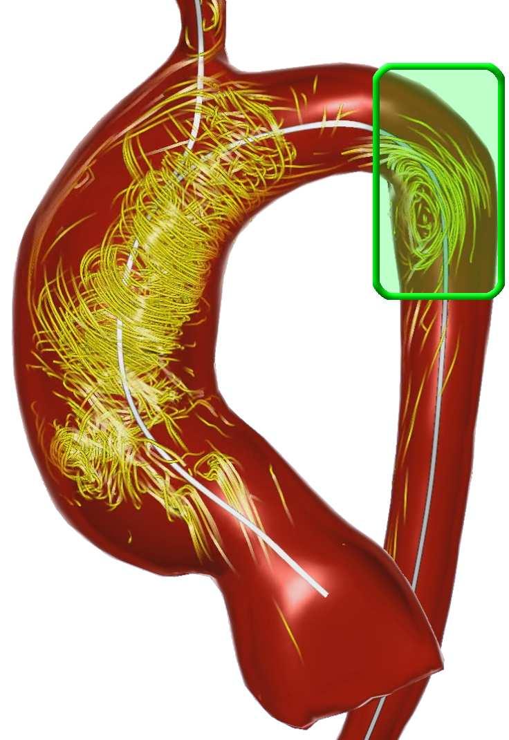 The first patient has systolic vortex flow in the dilated ascending