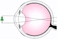 0) Figure 2: Emmetropia condition[4] Figure 3: Myopia condition[4] 2.2 Landolt Ring for Static Vision Visual acuity is called as static vision, when both of eyes and a target object stand still.