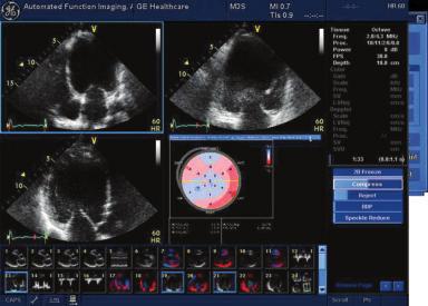 Cutting-edge AFI Assessing and quantifying left ventricle wall motion is easy with our Automated Function Imaging (AFI) tool, which delivers reproducible, systolic,