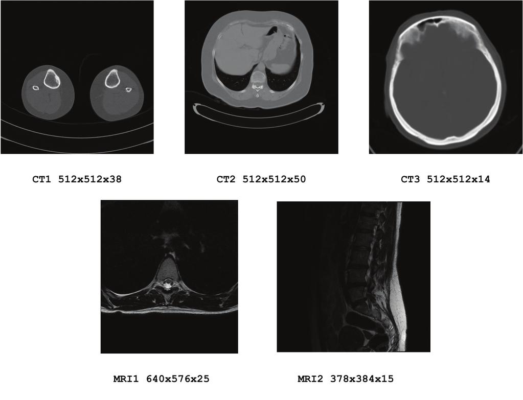 Lossless Predictive Compression of Medical Images Table 2 Entropy mean value after prediction of 150 CT images with different predictors.