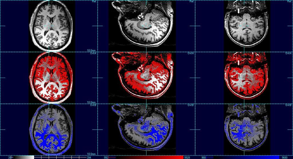 Brain Segmentation With Fuzzy C- Means 4T MRI, bias field