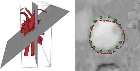 222 Int J CARS (2012) 7:217 224 Fig. 7 (left) 3D-cine blood-flow data with segmented surface and oblique 2D-cine validation slice.