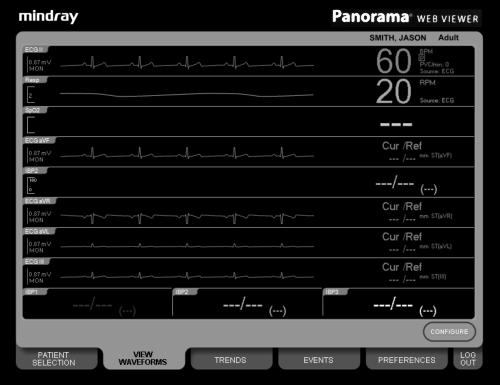 Viewing Near Real-Time Data Views Patient Name Waveform Tile Area Parameter Tile Area FIGURE 2-1 VIEW WAVEFORMS Tab - Waveforms View 2.1.1 Accessing the Waveforms View Once a patient is selected, click the VIEW WAVEFORMS tab.