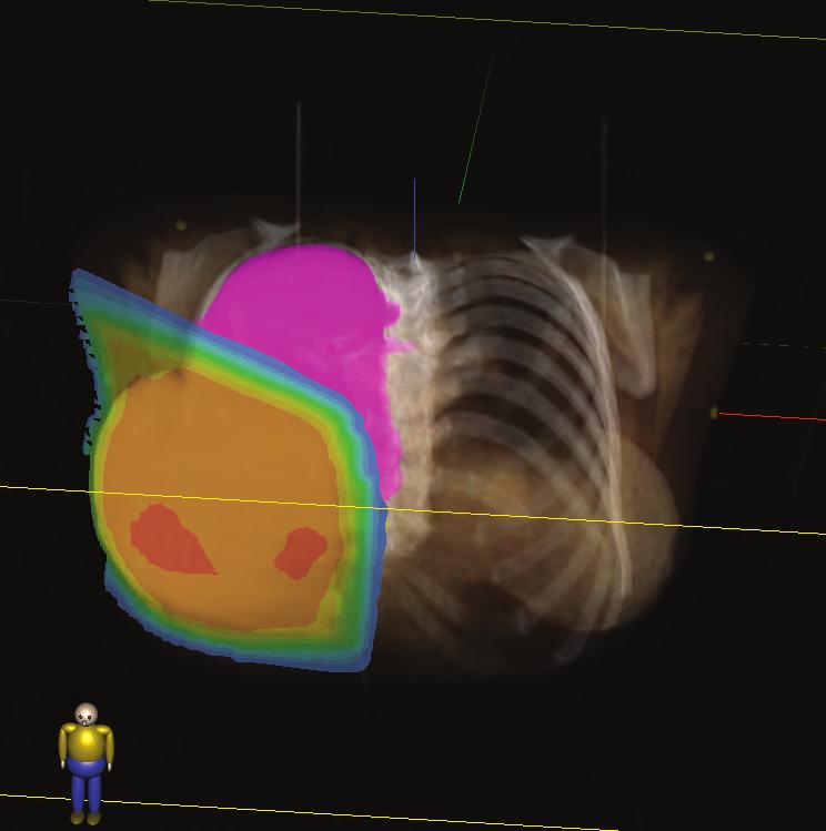 PCRT 3D The PCRT3D is a versatile 3D radiation treatment planning system featuring the most accurate algorithm calculations, the latest techniques in virtual simulation and the most advanced