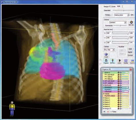 Virtual Simulation Interactive Real Time Virtual Simulation with all possible configurations and utilities available: Wedges, Blocks, Bolus, Compensators and
