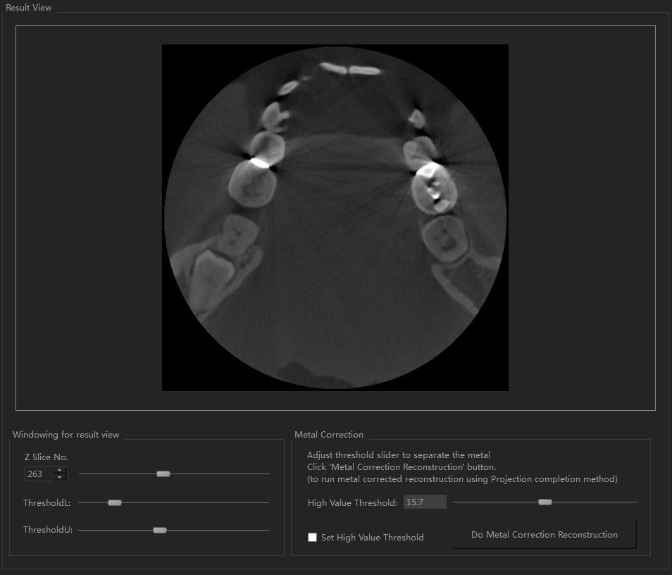 Advanced Features : MAR (Metal Artifact Reduction) Result view after initial reconstruction - VXRE has MAR (Metal Artifact Reduction) feature for Medical/Dental CT.