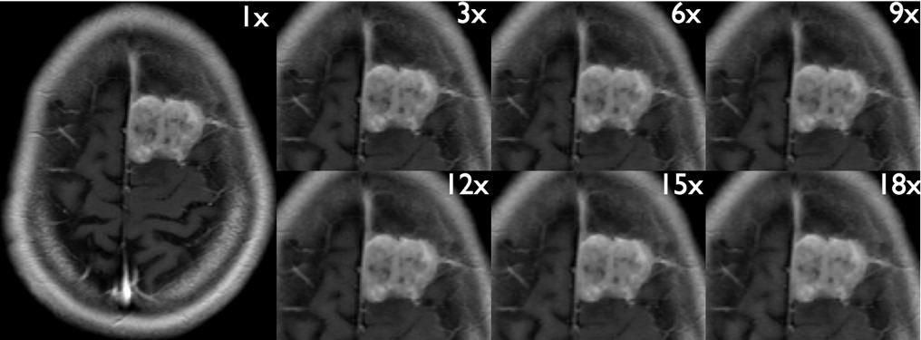 Dynamic Contrast Enhanced MRI Retrospective undersampling 3D T1-w SPGR: 256 x 186 x 10 (0.93 x 0.93 x 3.