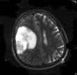 The tumor regions in the MRI brain images are segmented using active contour model. Benign tumor images used in this work are shown in fig.4. Malignant tumor images are shown in fig.5.