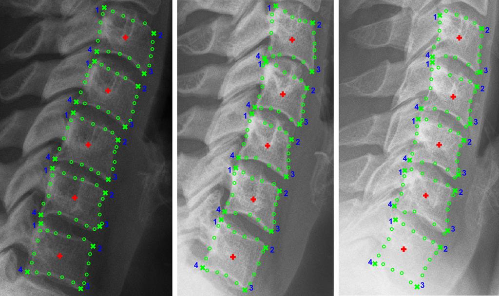 8 S.M.M.R. Al-Arif et al. studied in this work due to their ambiguity in lateral X-ray images similar to other work in the literature [3, 4]