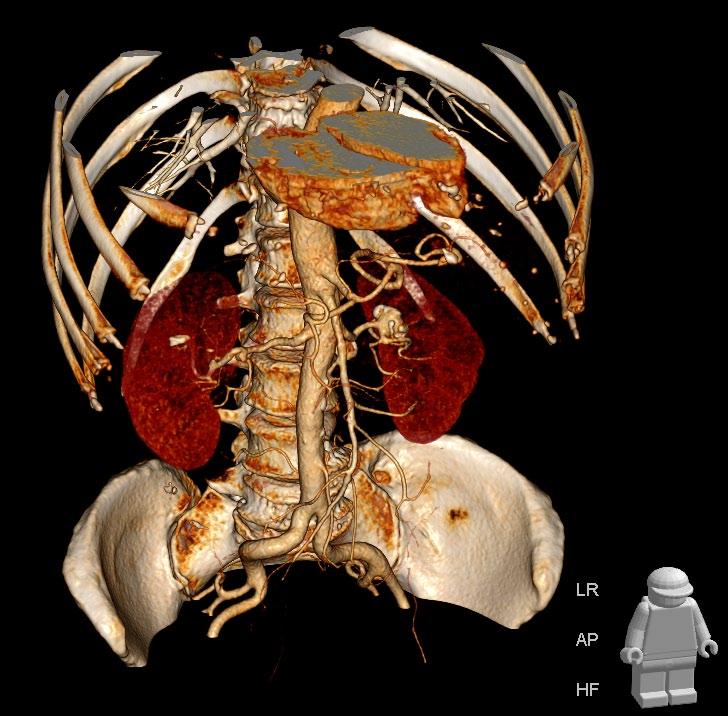 Getting started guide IMPAX Volume Viewing 3D Visualization & Segmentation This guide outlines the basic steps to perform and manipulate a 3D reconstruction of