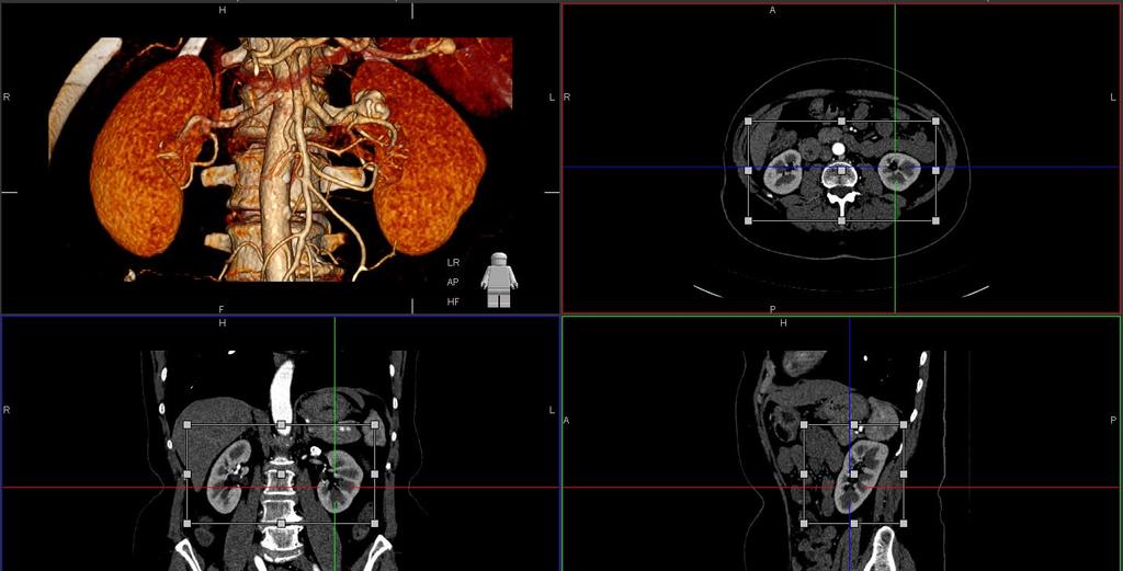 * requires the Volume Viewing Plus license. By default, the 3D transfer function will display bone and contrast-filled vessels (for CT datasets).