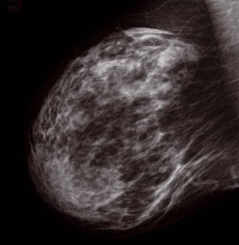 mammography modalities, allowing continued usage of your existing mammography X-ray