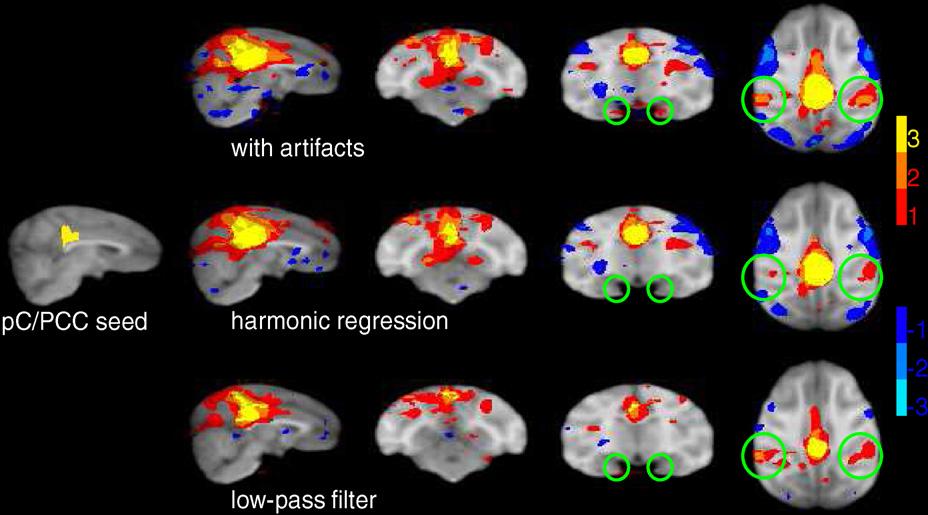1892 T. Teichert et al. / Neuropsychologia 48 (2010) 1886 1894 Fig. 6. Resting state network. fcmri maps for a seed in the posterior cingulate/precuneal cortex (leftmost panel). Conventions as in Fig.