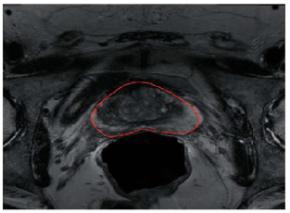 Fig. 1 shows the original MR image with the red arrows to indicate the weak boundary. Expert segments this area on the basis of their knowledge regarding the anatomical structure of the subject.