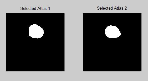 For atlas selection we use manifold ranking method which uses the label image constrain on the manifold subspace so as to reduce the effect of surrounding anatomical structure.