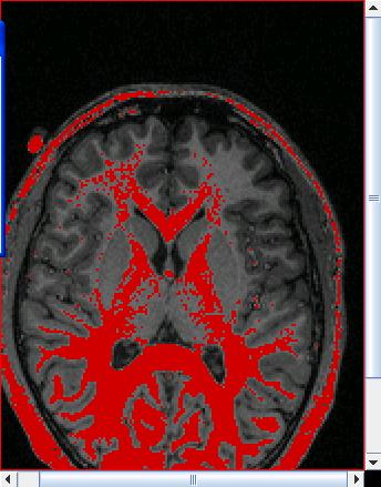 Threshold Method Applied To Brain MRI White matter segmentation Major failures: