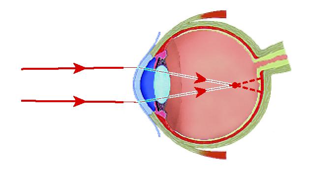 Refraction Section 2 Nearsightedness The image forms in front of