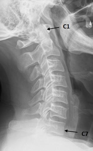 (a) (b) (c) Figure 1. In (a), we show a cervical spine radiograph, which shows all seven cervical vertebrae, starting with C1 at the top, down to C7.