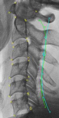 In addition, current cervical spine vertebrae segmentation approaches 5, 6 that have appeared in the literature are limited to segmentation of
