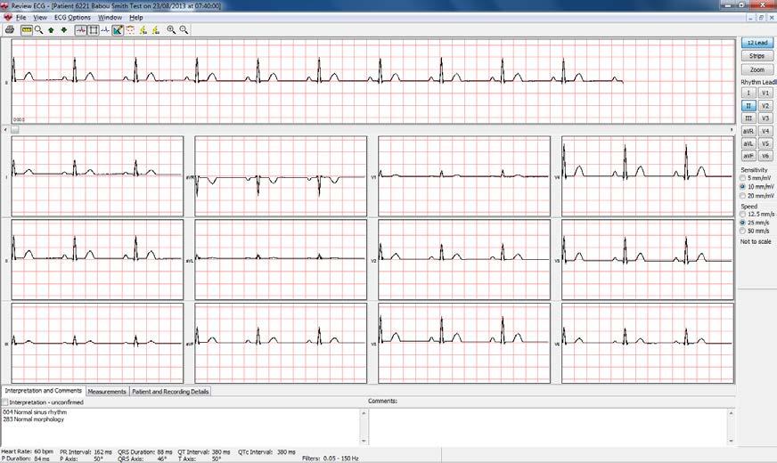 The data transfer should begin and a progress bar be shown. As the transfer completes, the ECG will be displayed in CardioView as seen below. 10.