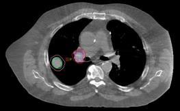 Challenges with single-iso MAT to multi-targets in SBRT Breath-hold lung SBRT. 7.